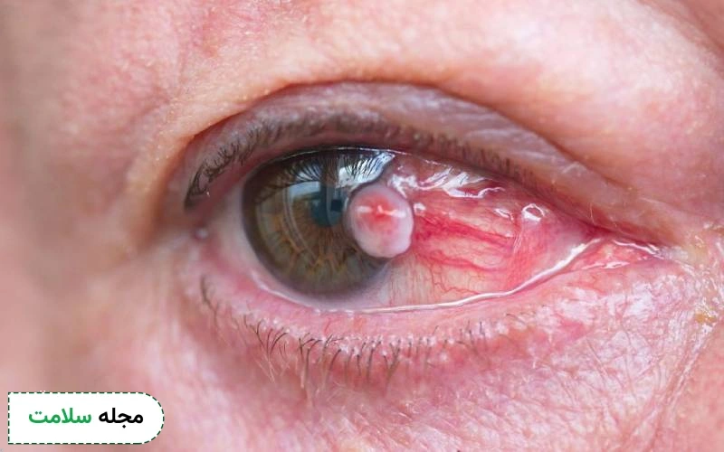 ملتحمه چشم چیست؟ + آشنایی با انواع بیماری ملتحمه چشم