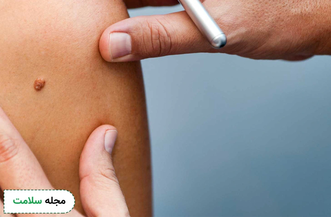 What-is-the-difference-between-warts-and-blisters