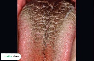 black hairy tongue