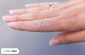 Blisters-of-dyshidrosis