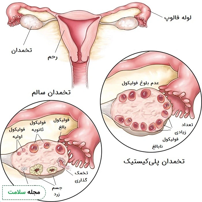 عکس کیست تخمدان