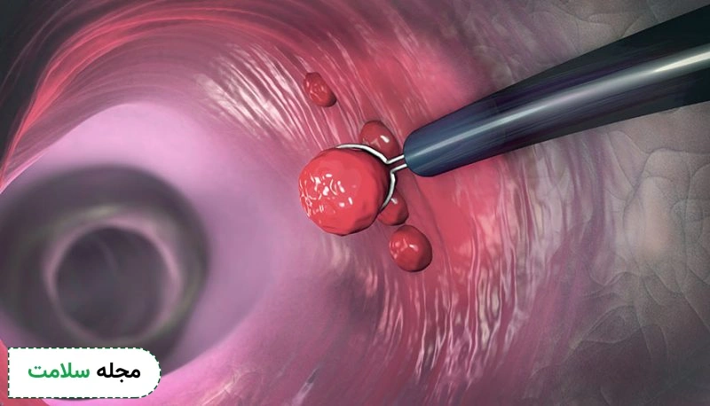 what is polyp