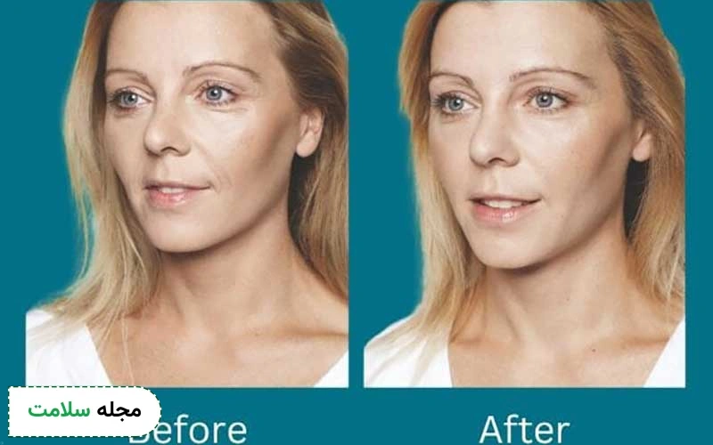 عکس قبل و بعد اسید تراپی برای لک چگونه است؟