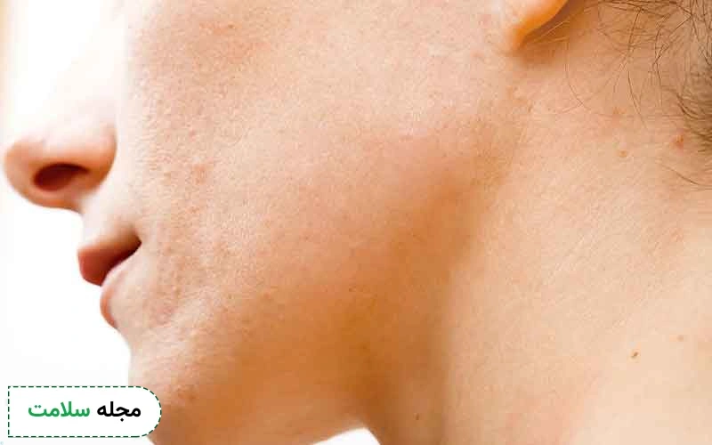 برداشتن خال با لیزر چیست؟