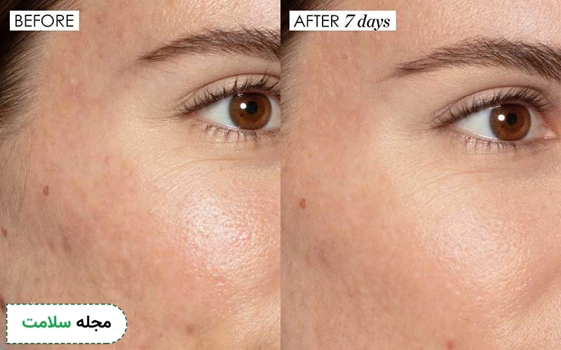 عوارض اسید تراپی صورت چیست؟