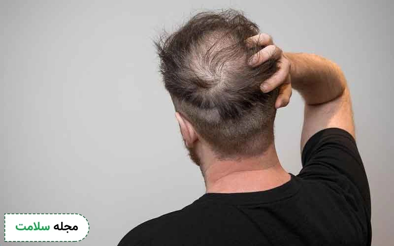 معایب کاشت مو به روش میکروگرافت چیست؟