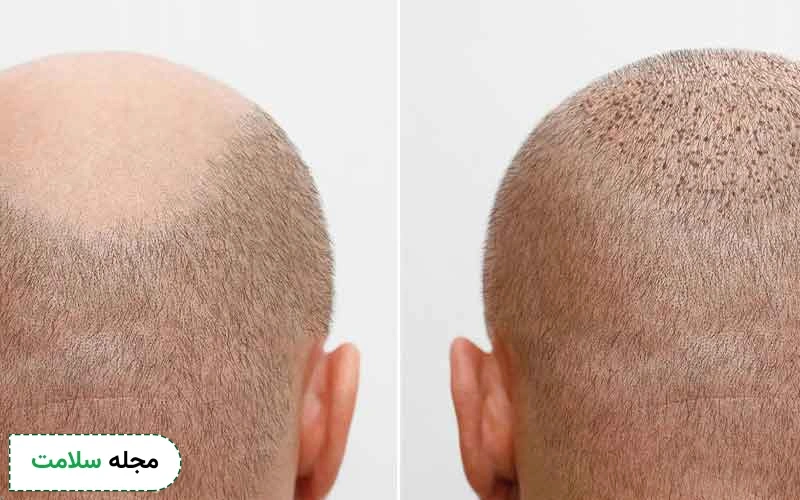 کاشت گرافت های مو در ناحیه دریافت کننده یکی از مراحل کاشت مو است.