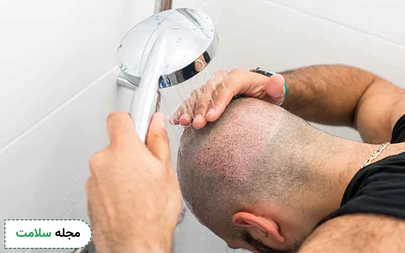 مراقبت های بعد از کاشت مو چیست؟