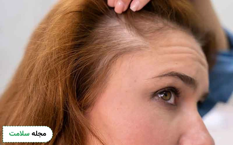 به منظور اثربخشی کاشت مو باید مراقبت ها به درستی رعایت شود.