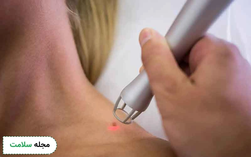 برداشتن خال با لیزر برای چه افرادی مناسب است؟