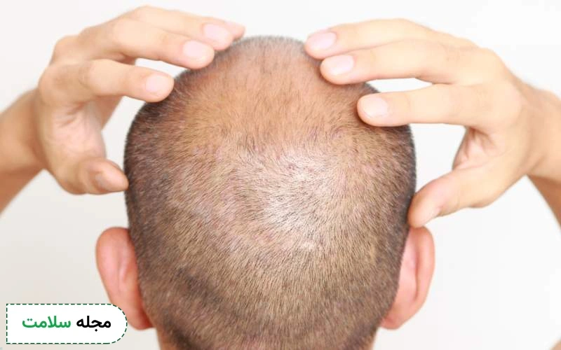 روش های مناسب مصرف پیاز بعد از کاشت مو چیست؟