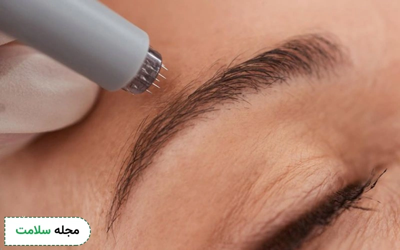 میکرونیدلینگ ابرو چقدر طول میکشه؟