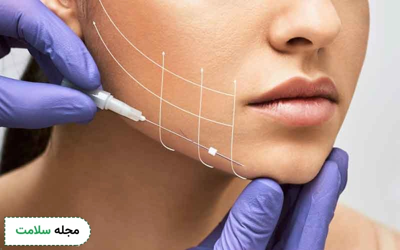 میزان تاثیرگذاری لیفت با نخ چقدر است؟