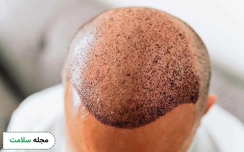 آمادگی برای انجام کاشت مو با سلولهای بنیادی چگونه است؟