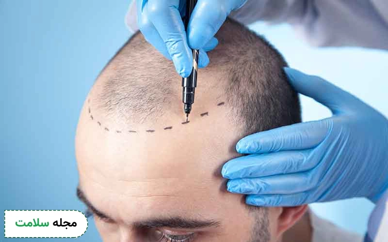 کاشت مو به روش تکثیری چیست؟
