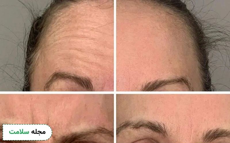 بوتاکس صورت از چند سالگی انجام میشود؟