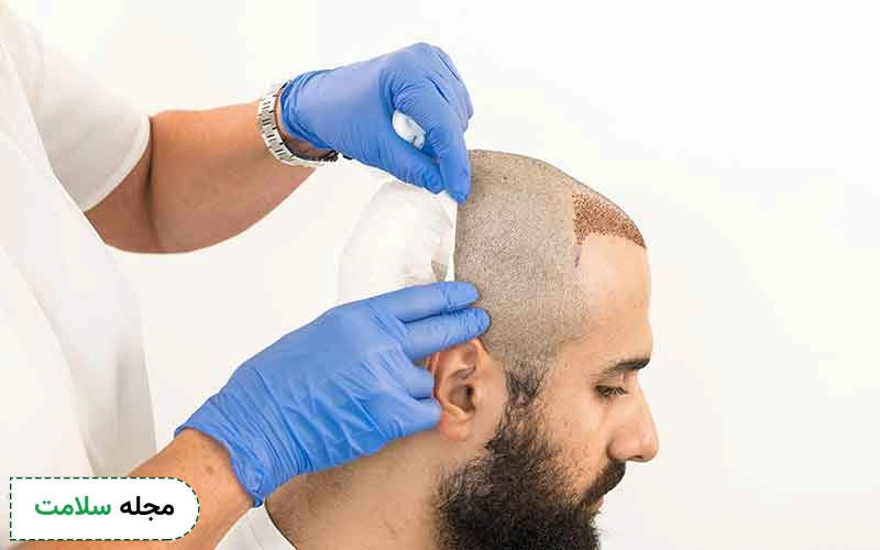 جدیدترین روش کاشت مو با سلولهای بنیادی است.