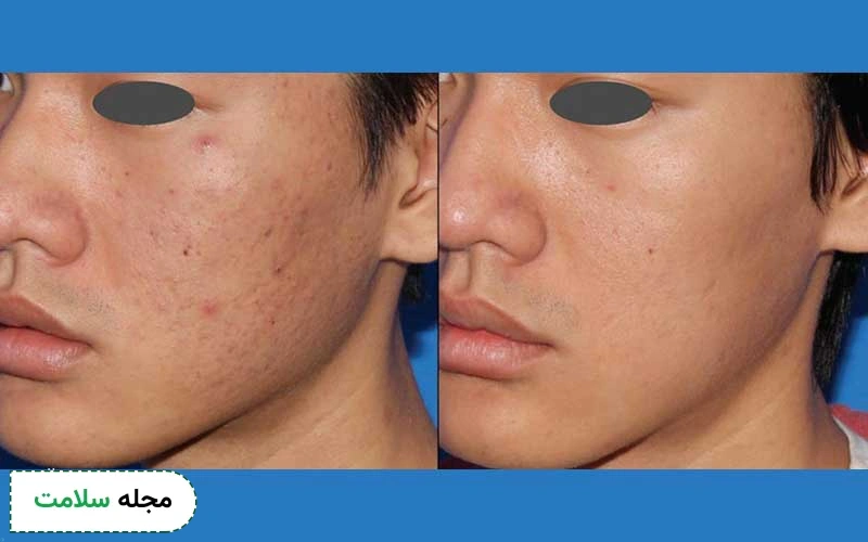 کاربردهای میکرونیدلینگ برای جای جوش چقدر موثر است؟