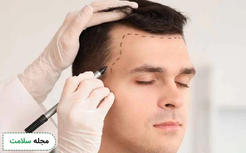 کاشت مو با تراکم بالا برای چه افرادی مناسب است؟