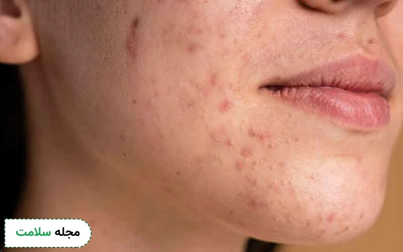 مزوتراپی صورت برای لک برای چه کسانی مناسب نیست؟