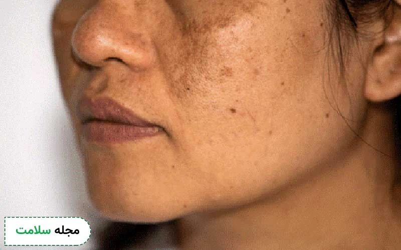 لکهای التهابی یا PIH بعد از میکرونیدلینگ چگونه هستند؟