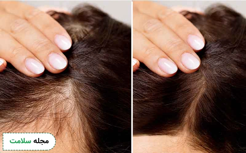 همه چیز درباره کاشت مو به روش تکثیری