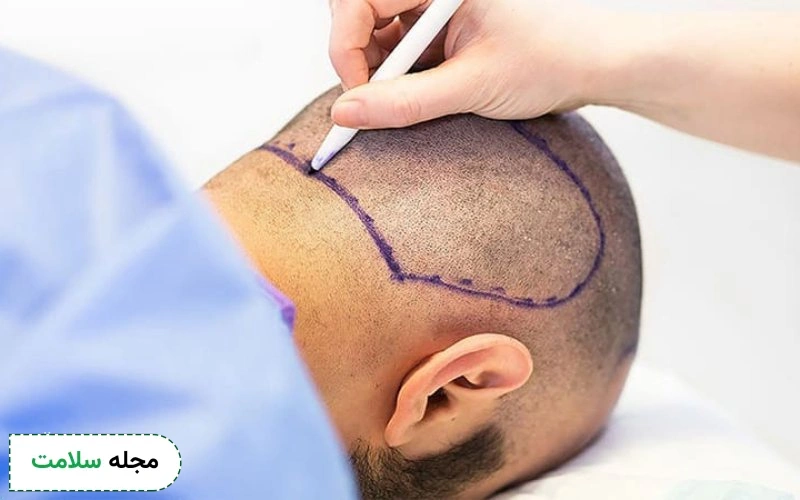 کاشت مو چند ساعت طول میکشد؟