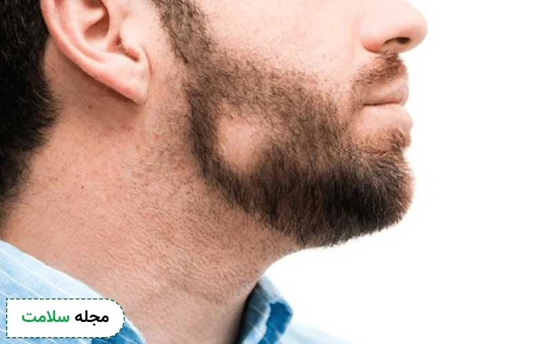 عوارض کاشت ریش و سبیل چیست؟