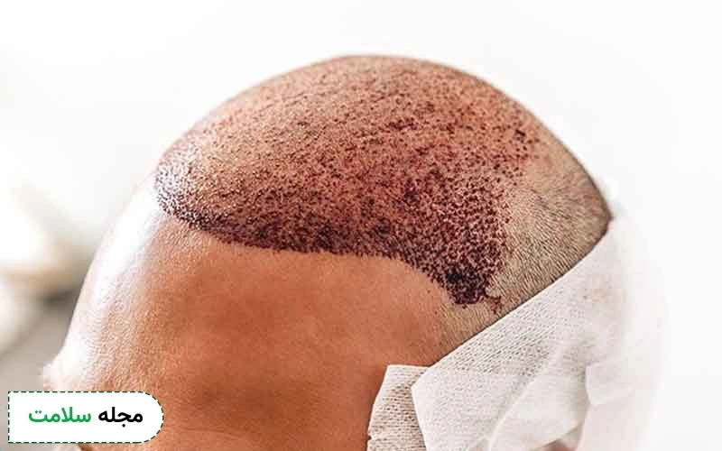 مراقبت بعد از کاشت مو چگونه انجام می شود؟
