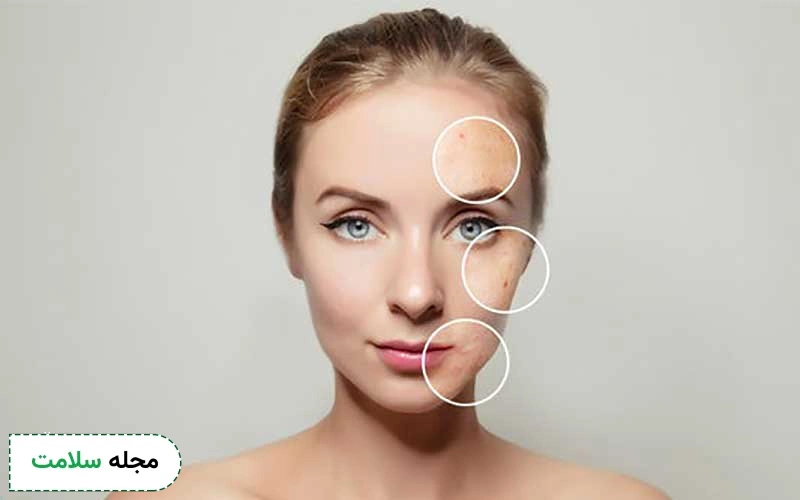 اسید تراپی برای جوش چگونه به درمان آن کمک می کند؟