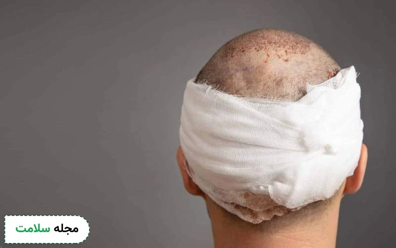 اشتباهات رایج در نحوه خواب بعد از کاشت مو چیست؟