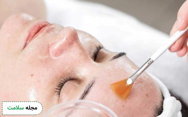 اسید تراپی برای لک تا چقدر در رفع آن موثر است؟