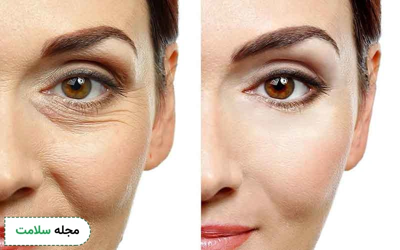 عکس قبل و بعد کربوکسی تراپی