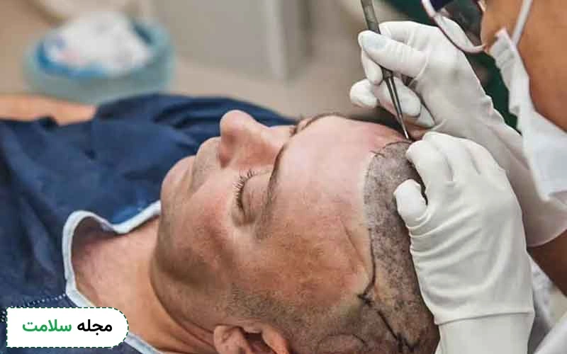 کاشت مو به روش میکروگرافت چیست؟