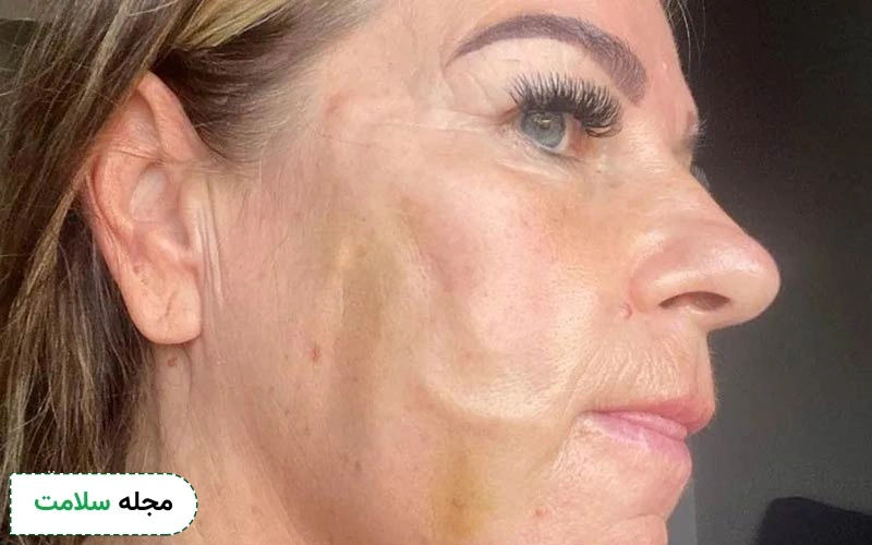 فرورفتگی صورت بعد از لیفت با نخ