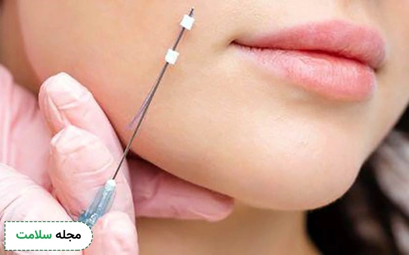 علل پارگی نخ لیفت صورت چیست؟