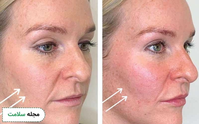 عکس قبل و بعد اسید تراپی صورت چگونه است؟