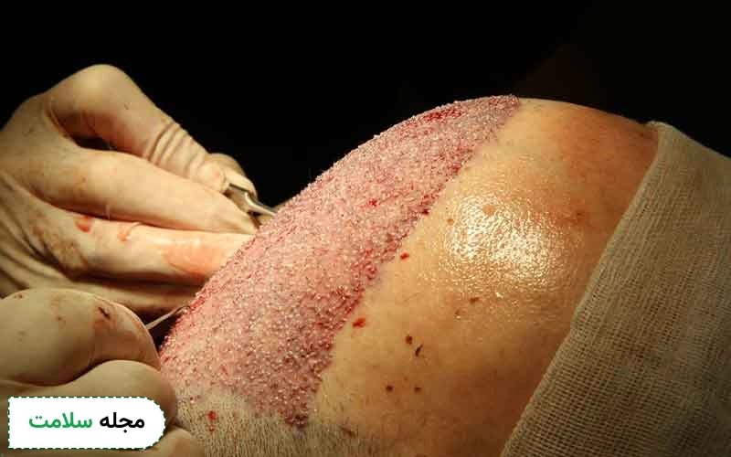 کاشت مو به روش dhi چیست؟