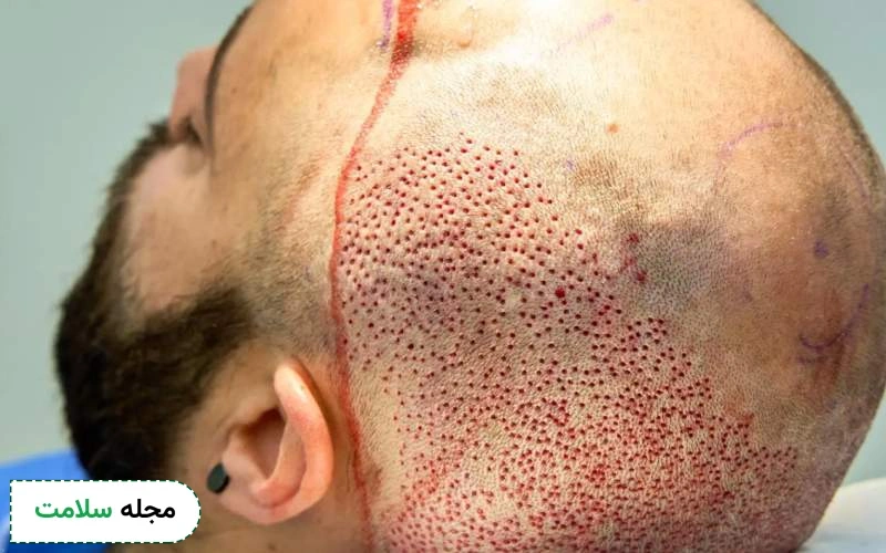 زمان رعایت نحوه خواب بعد از کاشت مو چگونه است؟