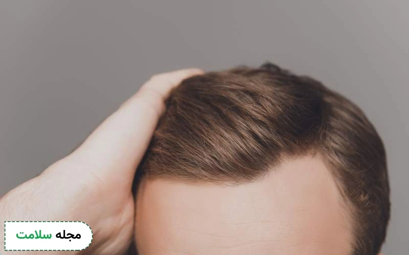 نکات مهم تغذیه ای بعد از کاشت مو چیست؟