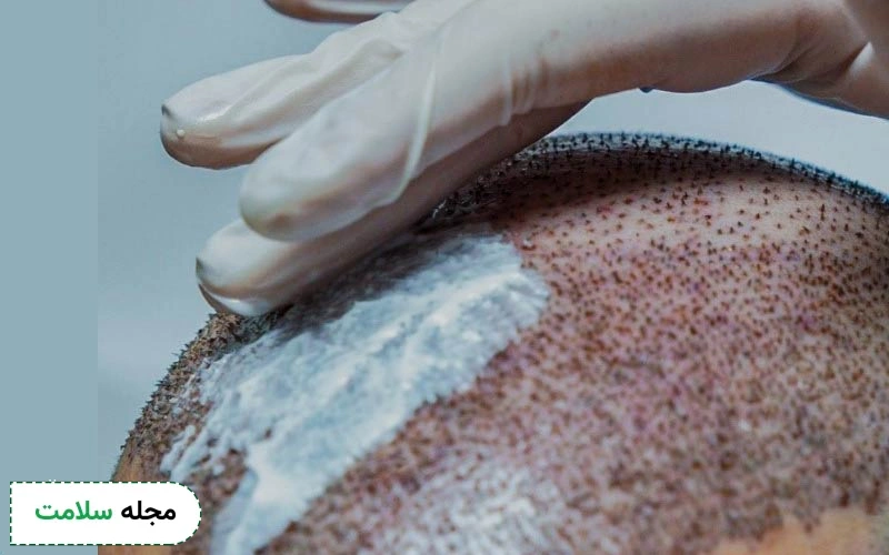درمان خارش سر بعد از کاشت مو چگونه است؟