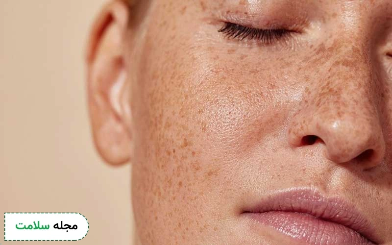آیا میکرونیدلینگ برای لک صورت درمانی موثر است؟