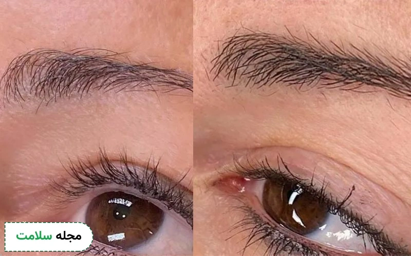 عکس میکرونیدلینگ ابرو قبل و بعد چگونه است؟