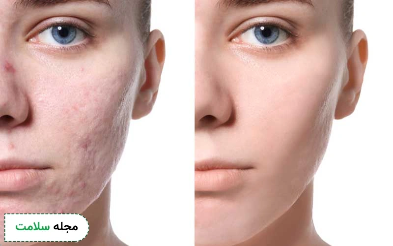 عکس مزوتراپی لک صورت حاکی از تاثیرگذاری آن است.