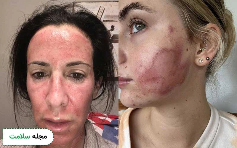 عکس سوختگی بعد از میکرونیدلینگ بدین شکل است.