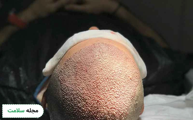 روش کاشت مو با سلولهای بنیادین تا چه اندازه موثر است؟