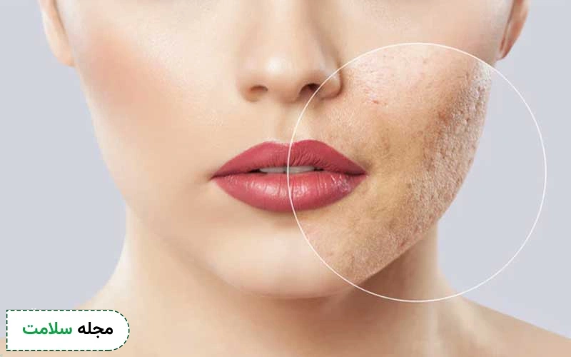 عوارض اسید تراپی برای جوش چیست؟