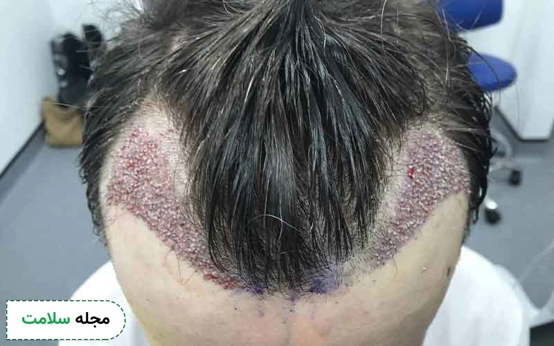 بررسی قدم به قدم مراحل کاشت مو