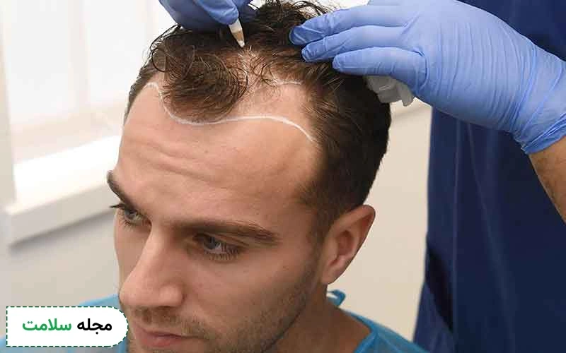 بررسی بهترین روش کاشت مو با تراکم بالا