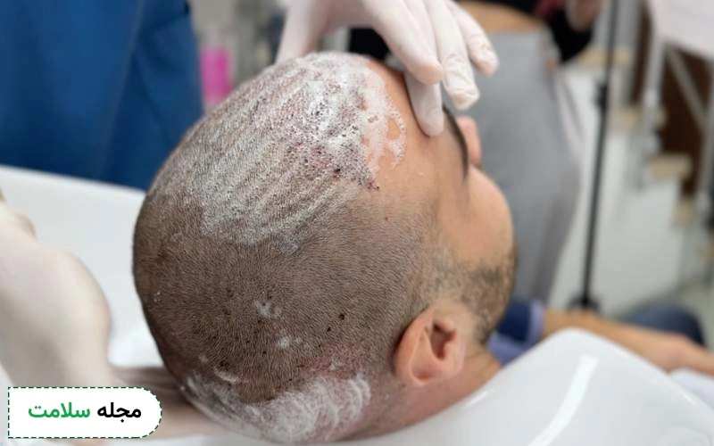 مراحل شستشوی سر بعد از کاشت مو باید منظم باشد.